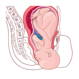 labor delivery