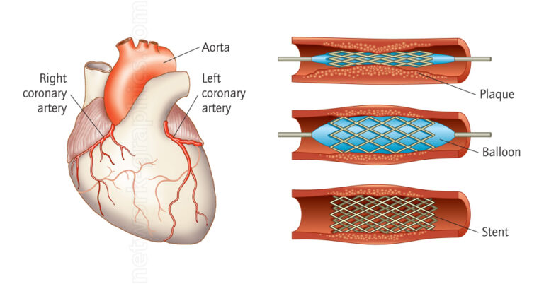 Human Heart and Coronary Artery Stent Cross-section | Network Graphics Inc.